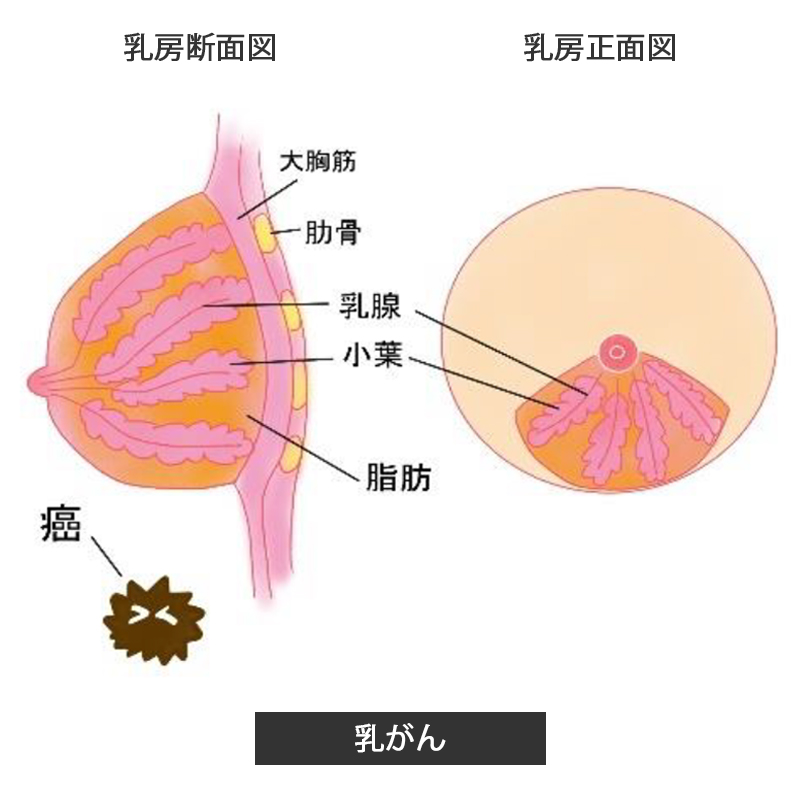 乳がん
